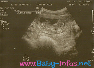 Ultraschallaufnahme 12. Woche der Schwangerschaft