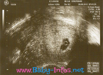 Ultraschall Aufnahme 5. Woche der Schwangerschaft