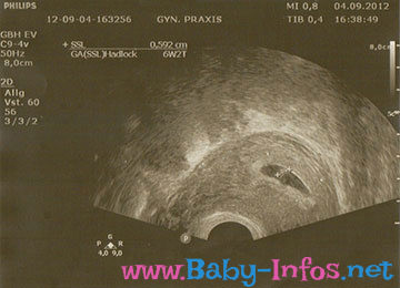 Ultraschallbilder in der 7. Schwangerschaftswoche